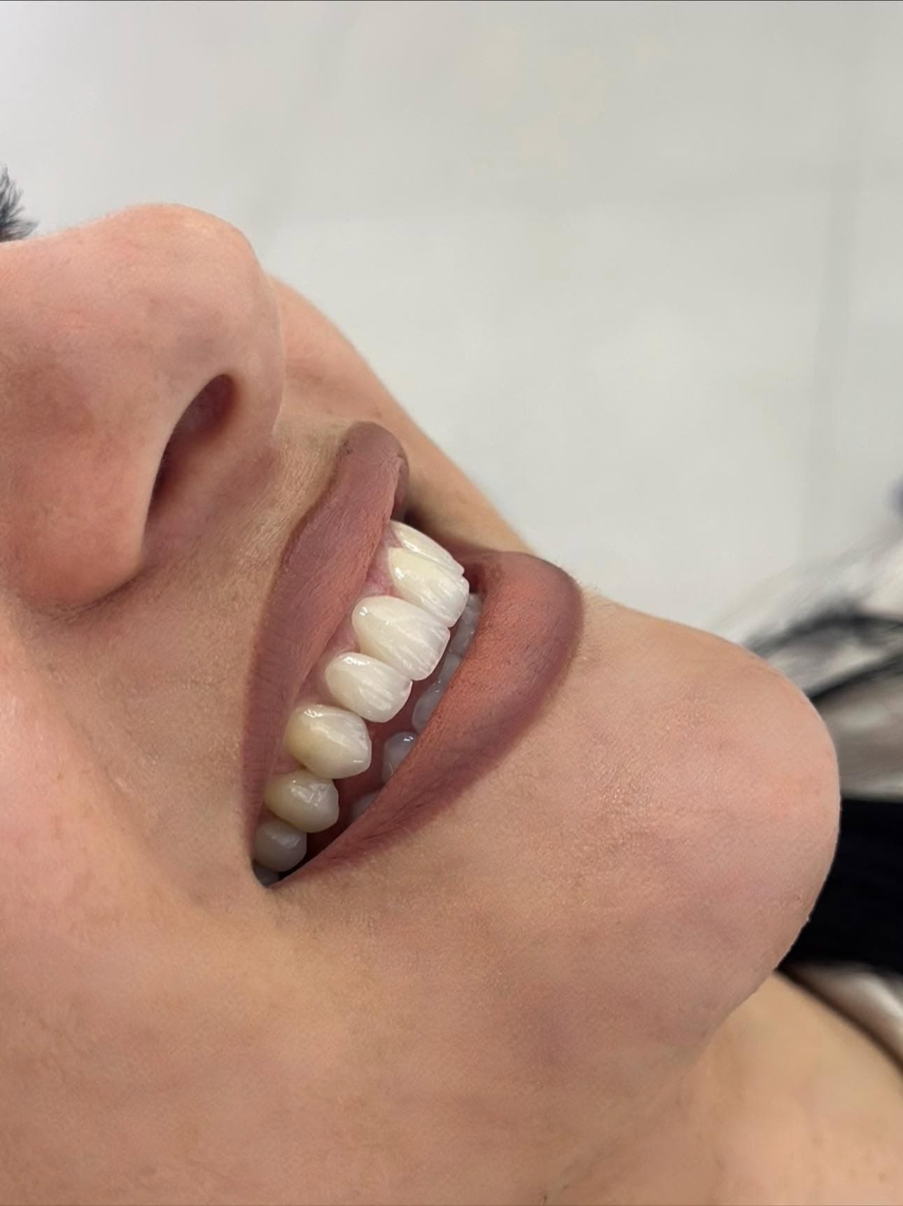 Rezultati përfundimtar i një trajtimi në Lata DENT, pamje anësore
